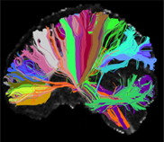 A High Angular Resolution Diffusion Image (HARDI) of the human brain that shows long distance connections, or tracts, grouped on the basis of their anatomical neighborhood.
