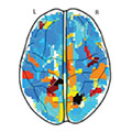 Image showing differences in fMRI activation between children with and without anhedonia during reward anticipation.